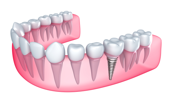 Implant Dentaire Tunisie Pose Implant Dentaire Ceramique Prix